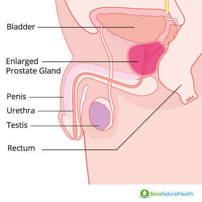 enlarged prostate 37 year old