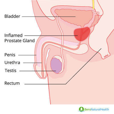chronic prostatitis/chronic pelvic pain syndrome