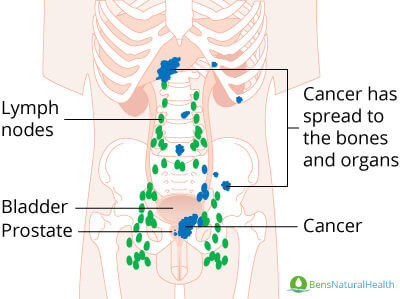 prostate cancer with metastasis to lymph nodes)