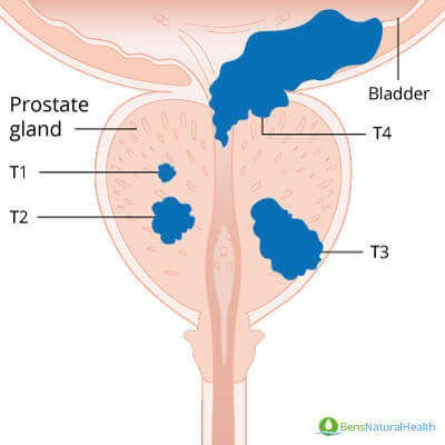 prostate explained stage