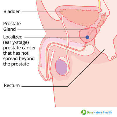 prostatitis késztet a wc- re