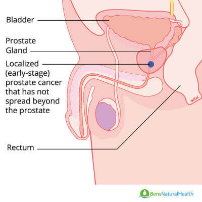 prostate cancer anatomy