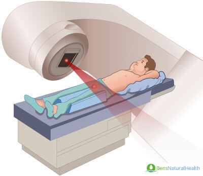 radiation therapy for prostate cancer)