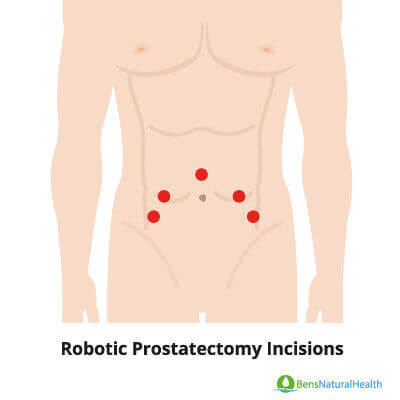 robotic prostatectomy