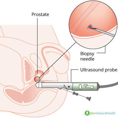 5 Side Effects of a Prostate Biopsy | Test for Prostate Cancer 