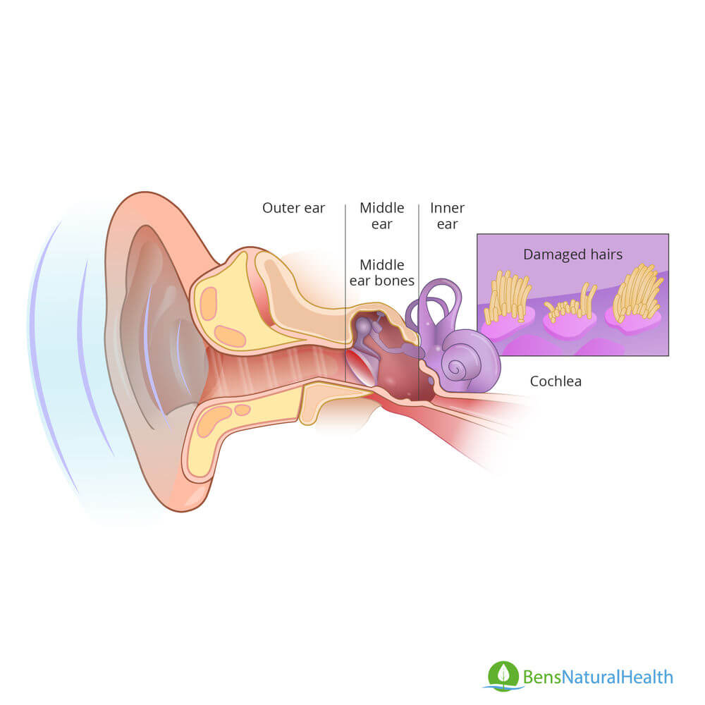 Amazon.com: Acupressure Earrings，Acupressure Tinnitus Relief Earrings -  Relief for Ringing Ears, Free Your Ears and Enjoy Tranquility (3BOX) :  Health & Household