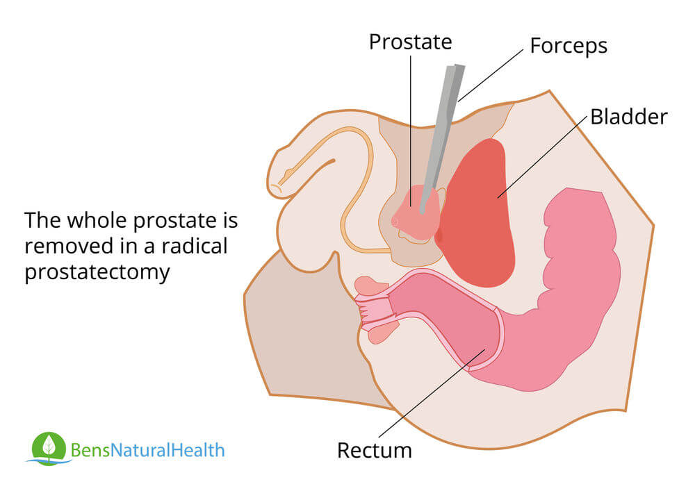 radical prostatectomy