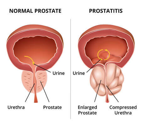 A Guy Prostatitisben