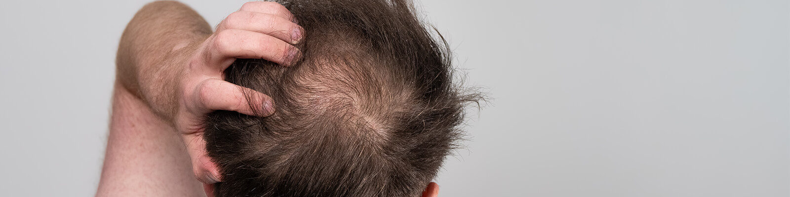 Finasteride vs Minoxidil: Which One Is Right For Your Hair Loss?