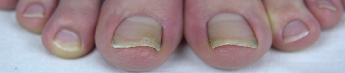 How to Treat Yellow Toenails